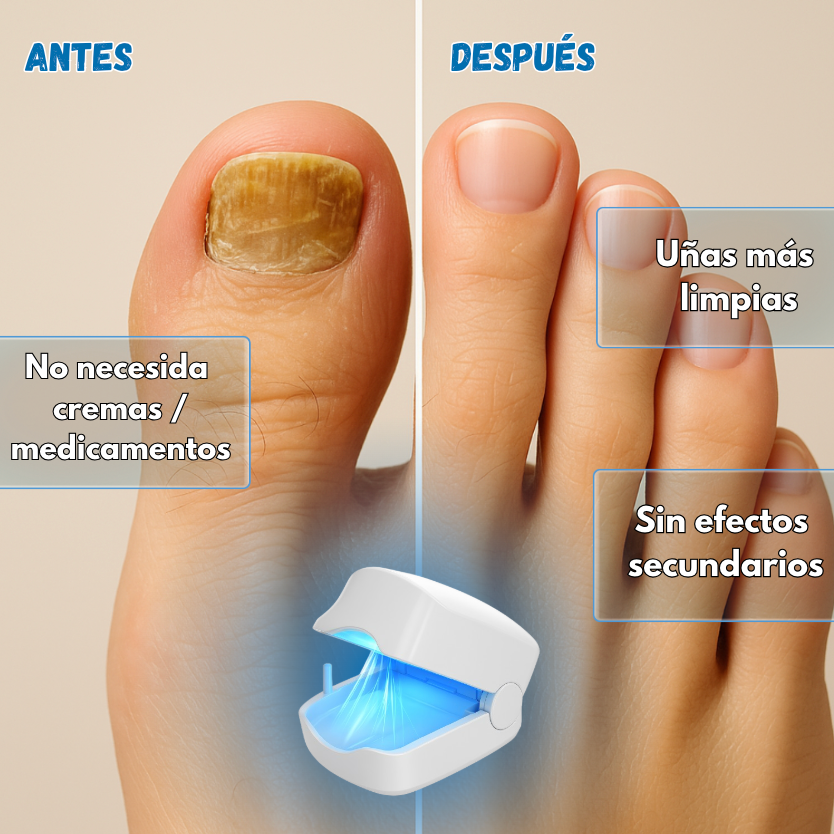 Dolxia - Dispositivo Anti-Hongos en las Uñas
