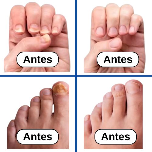 Dolxia - Dispositivo Anti-Hongos en las Uñas